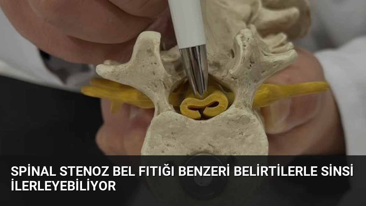 Spinal Stenoz Bel Fıtığı Benzeri Belirtilerle Sinsi İlerleyebiliyor